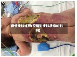 疫情皮肤坏死(疫情对皮肤状态的影响)