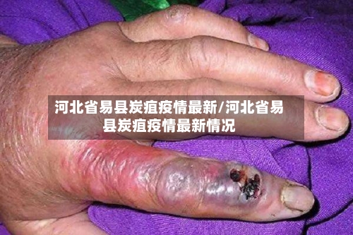 河北省易县炭疽疫情最新/河北省易县炭疽疫情最新情况-第1张图片