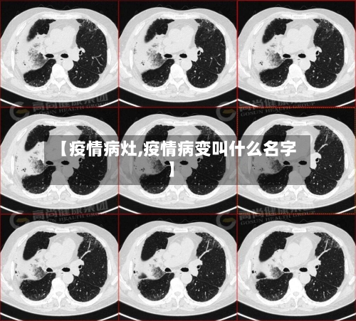 【疫情病灶,疫情病变叫什么名字】-第1张图片