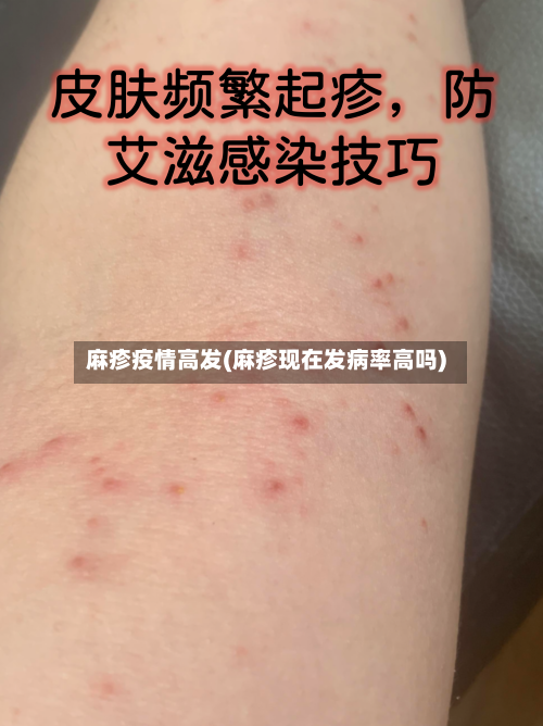 麻疹疫情高发(麻疹现在发病率高吗)-第1张图片